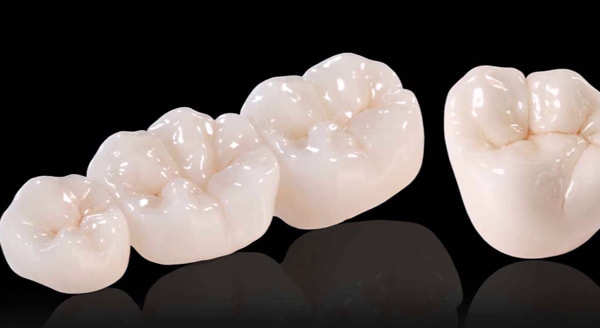 st catharines dental crown cost