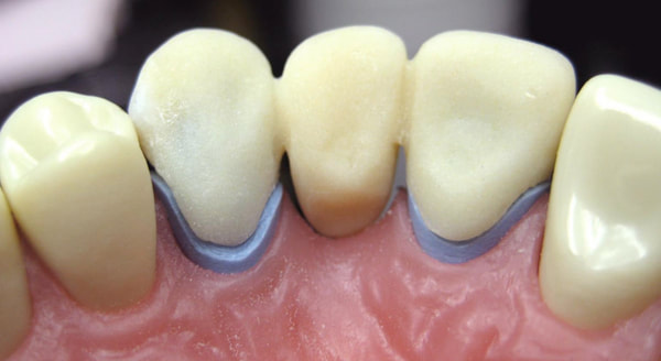 best tooth bridge dentist st catharines