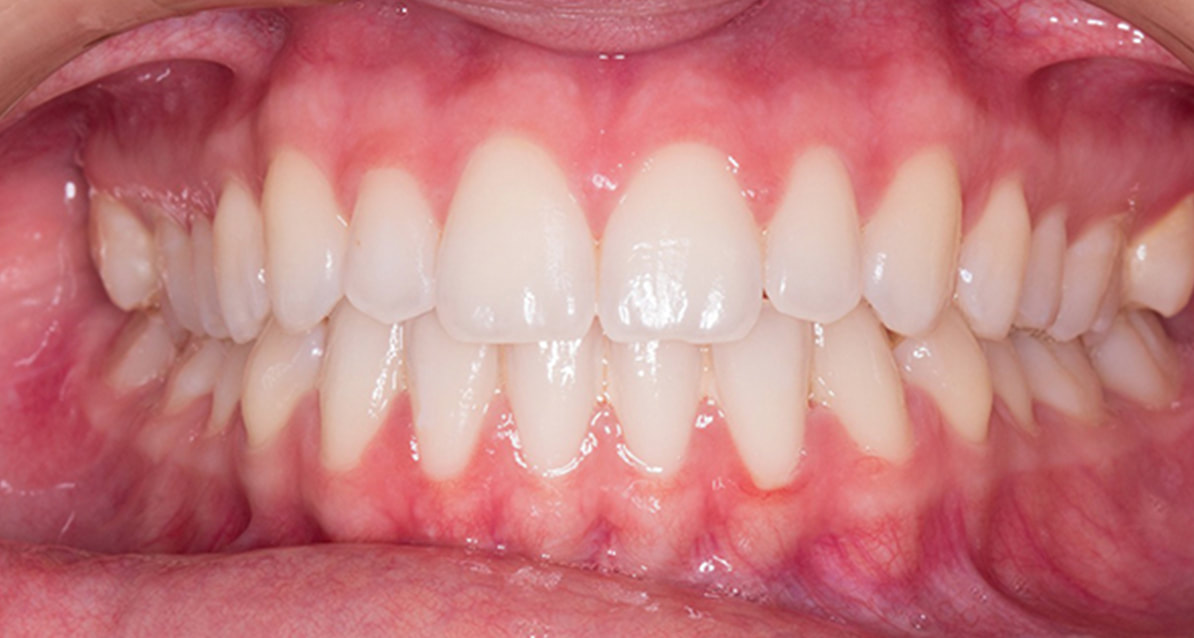 st catharines dental veneers