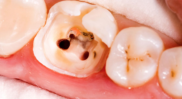 st catharines ontario root canals